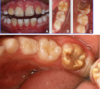 macchie bianche sui denti studio scarozza dentista sdan giovanni