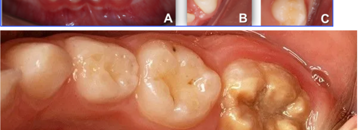 macchie bianche sui denti studio scarozza dentista sdan giovanni