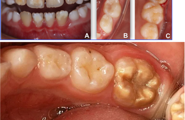 macchie bianche sui denti studio scarozza dentista sdan giovanni