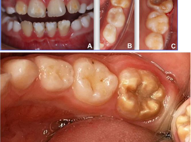 macchie bianche sui denti studio scarozza dentista sdan giovanni